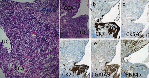 Clear Cell Adenocarcinoma of the Ureter Similar to Clear Cell Renal Cell Carcinoma Histology.