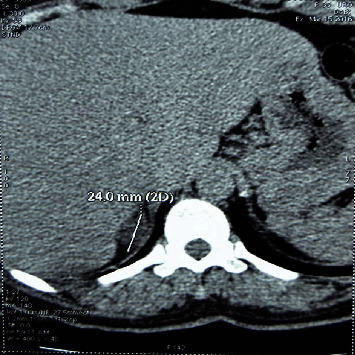 The Management of Primary Hyperaldosteronism in a Poor Technology Environment.