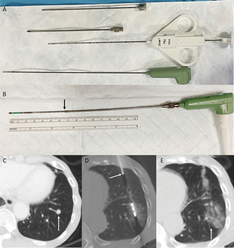 Combined Biopsy and Imaging-Guided Microwave Ablation by Using a Coaxial Guiding Needle.