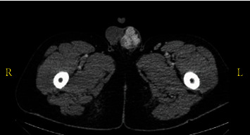 A Rare Case of a Solitary Fibrous Tumor of the Spermatic Cord.