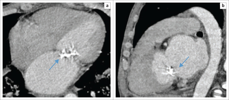 Prevalence of incidental premature cardiac calcifications in an HIV-infected South African population using conventional computed tomography chest radiography.