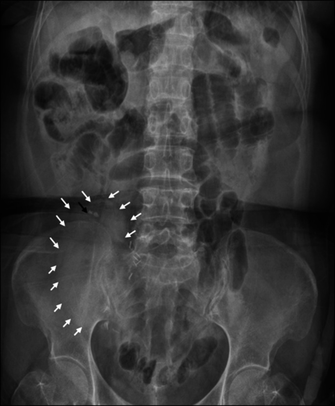 Distal Renal Tubular Acidosis Accompanied by Severe Hypophosphatemia Mistaken as Fanconi Syndrome in a Kidney-Transplant Patient.