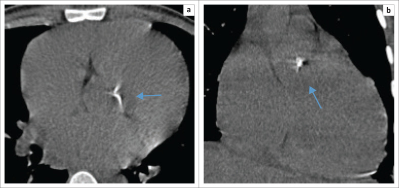 Prevalence of incidental premature cardiac calcifications in an HIV-infected South African population using conventional computed tomography chest radiography.
