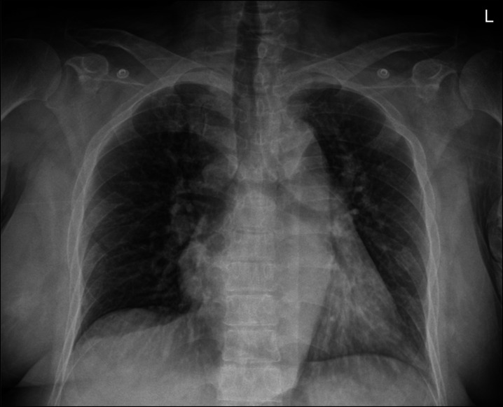 Distal Renal Tubular Acidosis Accompanied by Severe Hypophosphatemia Mistaken as Fanconi Syndrome in a Kidney-Transplant Patient.