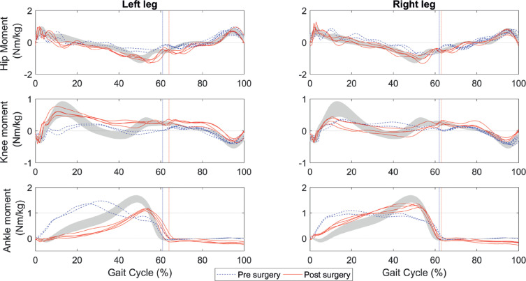 Improved Gait Capacity after Bilateral Achilles Tendon Lengthening for Irreducible Pes Equinus Due to Hereditary Spastic Paraplegia: a Case Report.