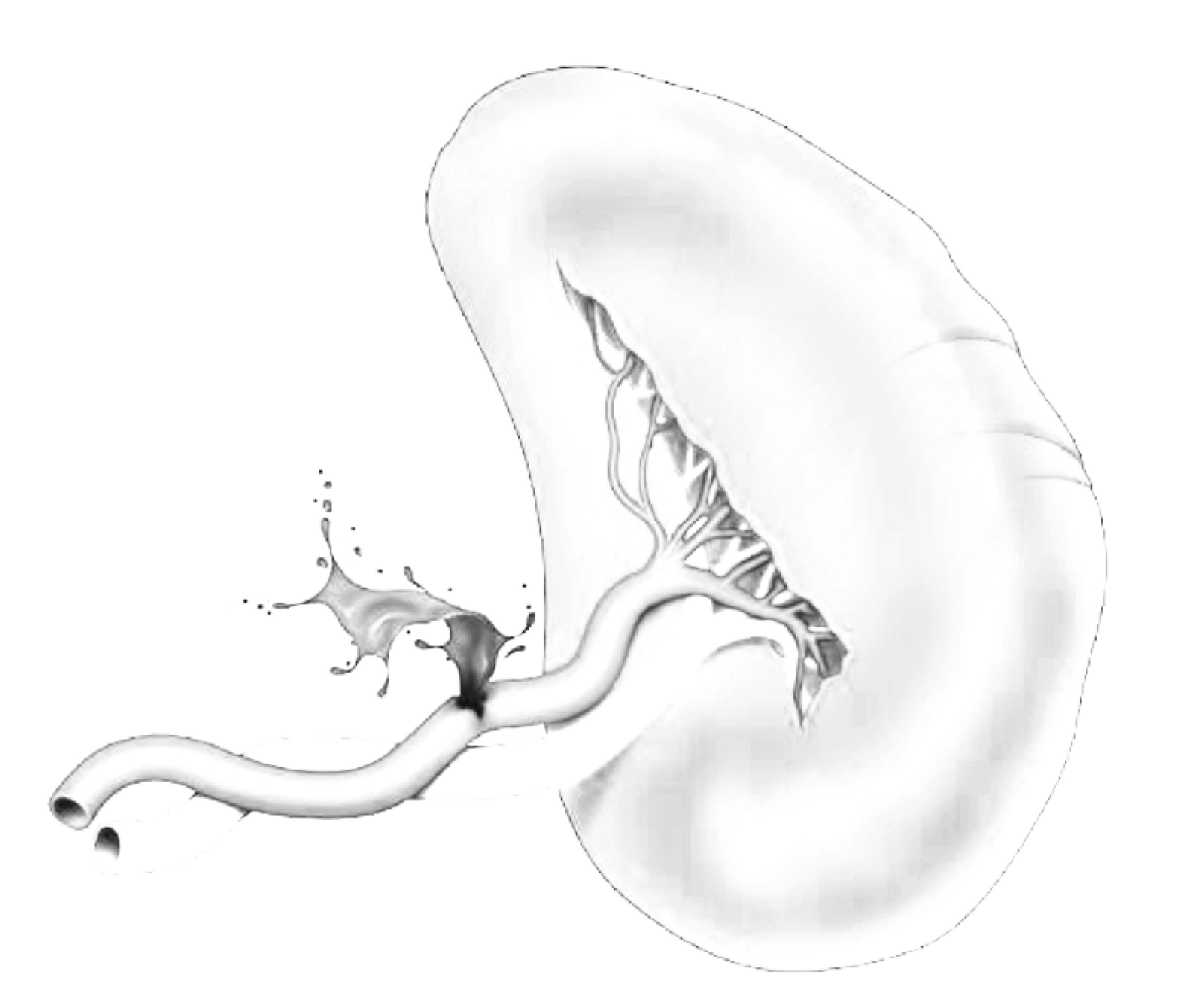 Damage control surgery for splenic trauma: "preserve an organ - preserve a life".