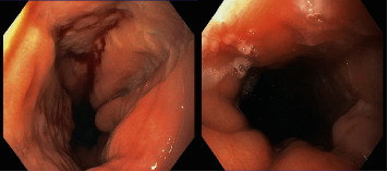 A Patient with Eosinophilic Esophagitis and Herpes Simplex Esophagitis: A Case Report and Literature Review.