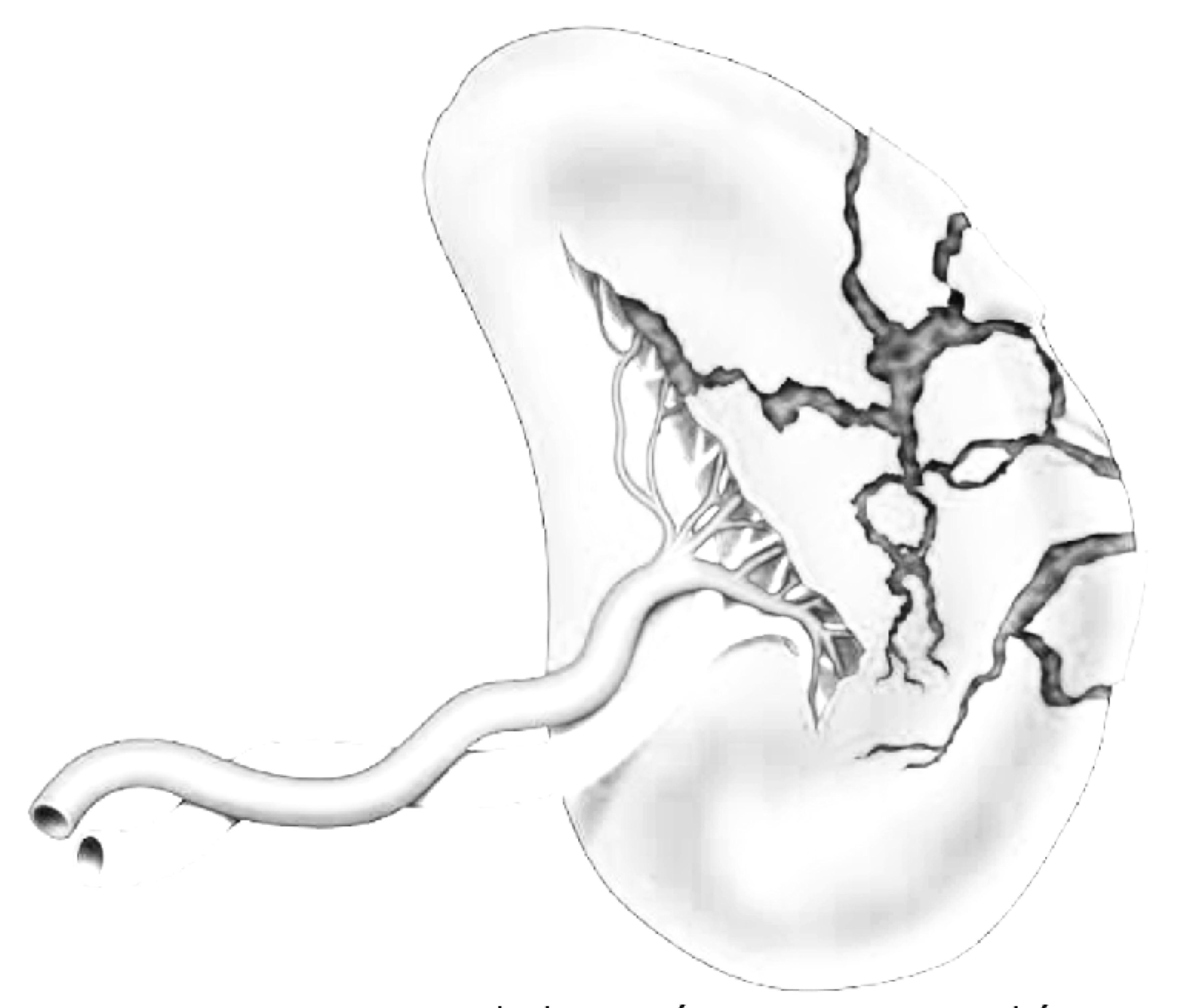 Damage control surgery for splenic trauma: "preserve an organ - preserve a life".