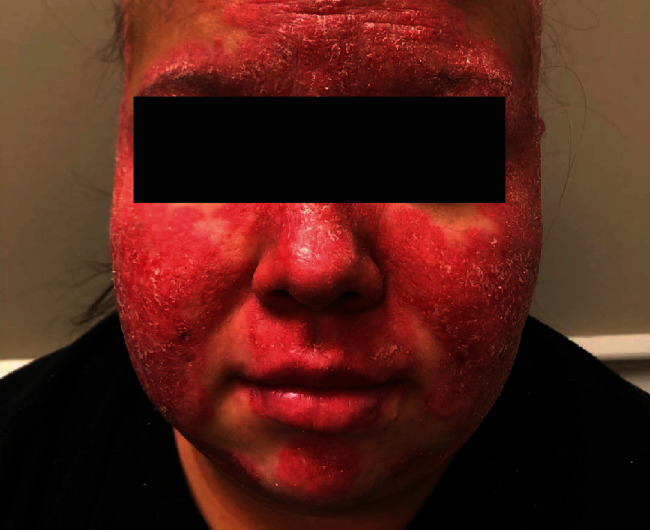 Cutaneous Manifestations of "Lupus": Systemic Lupus Erythematosus and Beyond.