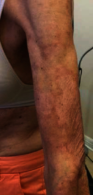 Cutaneous Manifestations of "Lupus": Systemic Lupus Erythematosus and Beyond.