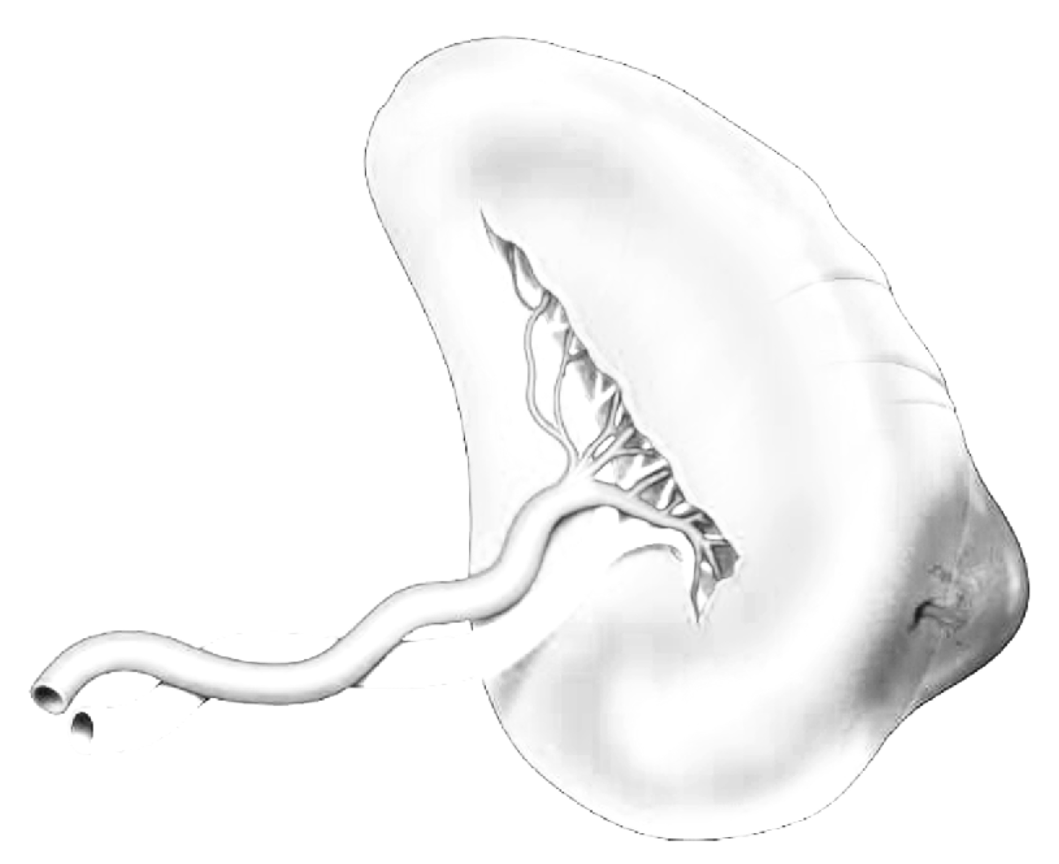 Damage control surgery for splenic trauma: "preserve an organ - preserve a life".