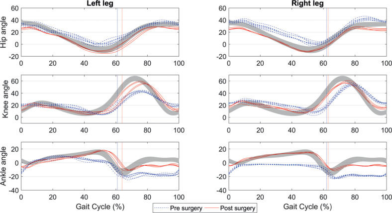 Improved Gait Capacity after Bilateral Achilles Tendon Lengthening for Irreducible Pes Equinus Due to Hereditary Spastic Paraplegia: a Case Report.