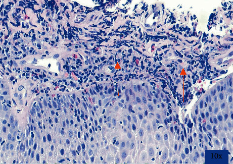 A Patient with Eosinophilic Esophagitis and Herpes Simplex Esophagitis: A Case Report and Literature Review.