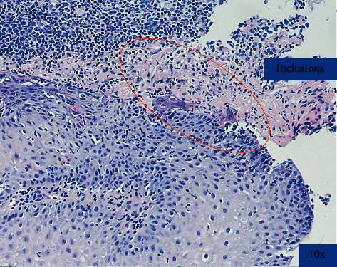 A Patient with Eosinophilic Esophagitis and Herpes Simplex Esophagitis: A Case Report and Literature Review.