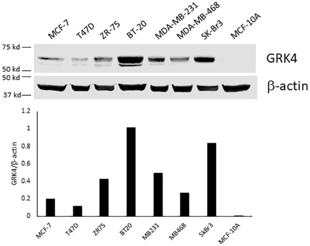 The Hypertension Related Gene G-Protein Coupled Receptor Kinase 4 Contributes to Breast Cancer Proliferation.