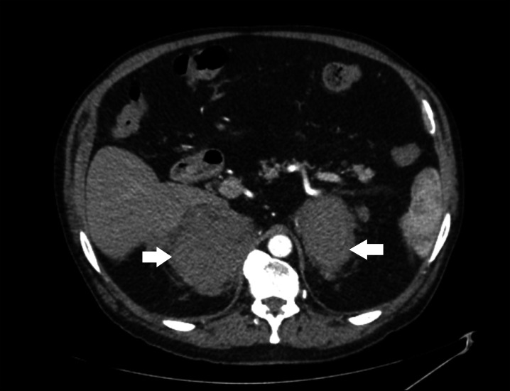 Bilateral Adrenal Haemorrhages Presenting as Adrenal Insufficiency.