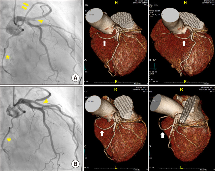 Two Cases of Single Coronary Artery Ostium Presenting with Acute Myocardial Infarction: Right Coronary Artery Arising from Left Anterior Descending Artery.