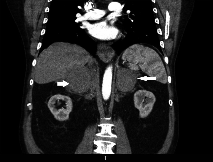 Bilateral Adrenal Haemorrhages Presenting as Adrenal Insufficiency.