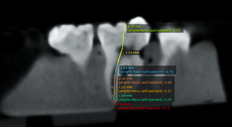 Root canal length measurement of molar teeth using conebeam computed tomography (CBCT): comparison of two dimensional versus three-dimensional methods.