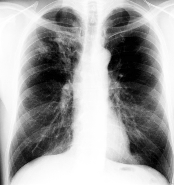 Allergic bronchopulmonary aspergillosis (ABPA) in an atopic patient with difficult-to-expectorate airway secretions.