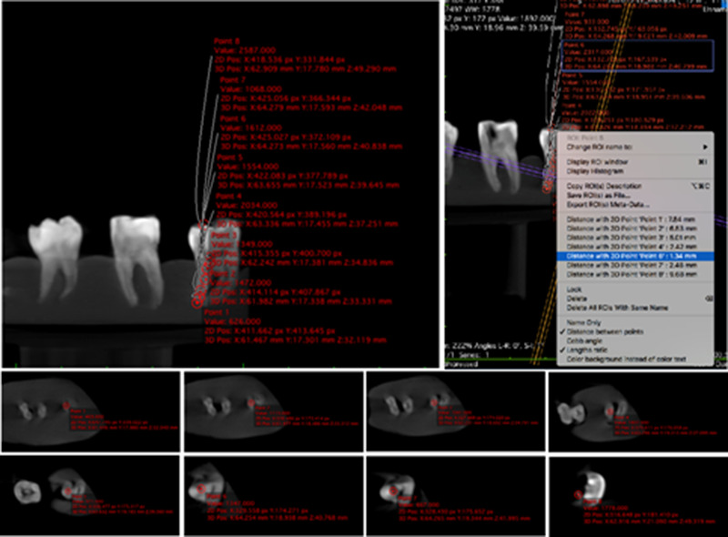 Root canal length measurement of molar teeth using conebeam computed tomography (CBCT): comparison of two dimensional versus three-dimensional methods.