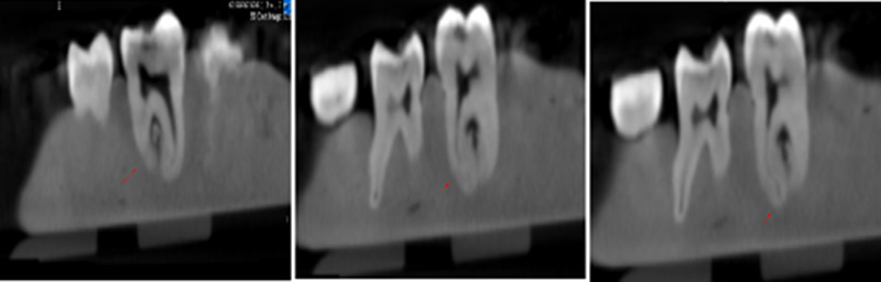 Root canal length measurement of molar teeth using conebeam computed tomography (CBCT): comparison of two dimensional versus three-dimensional methods.