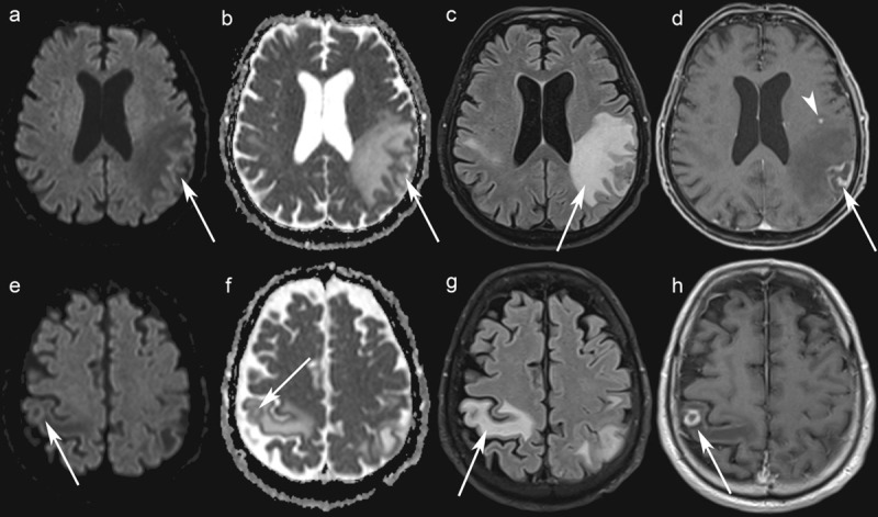 Neurotoxoplasmosis in a Patient with Chronic Lymphocytic Leukemia.