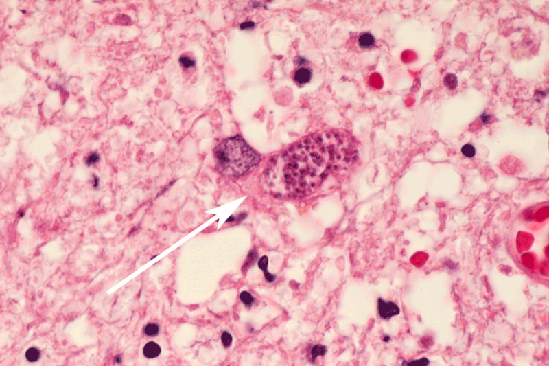 Neurotoxoplasmosis in a Patient with Chronic Lymphocytic Leukemia.