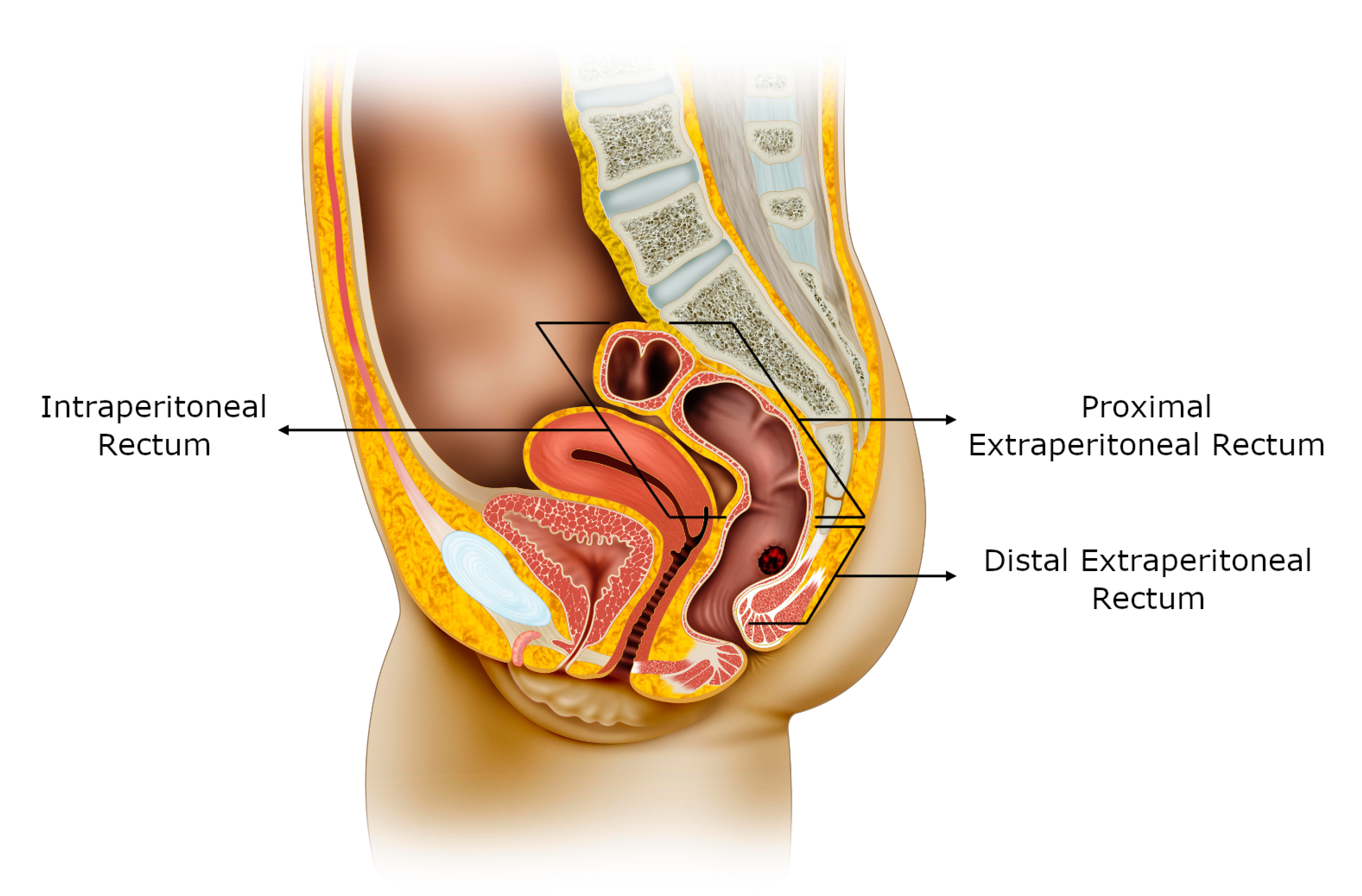 Rectal damage control: when to do and not to do.