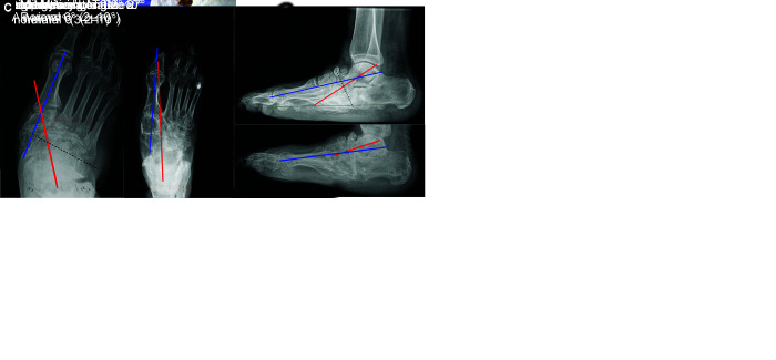 Correction of Foot Deformities from Charcot Arthropathy with the Taylor Spatial Frame: A 7-14-year Follow-up.