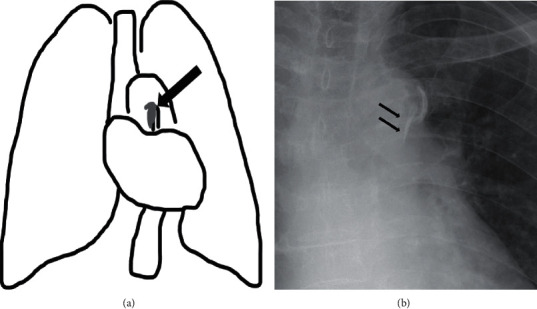 Ascending Aortic Calcification as a Potential Predictor for Low Bone Mineral Density: A Pilot Study.