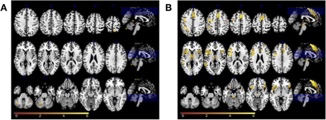 Cerebellar and Cortical Correlates of Internal and External Speech Error Monitoring.