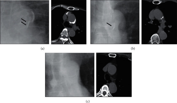 Ascending Aortic Calcification as a Potential Predictor for Low Bone Mineral Density: A Pilot Study.