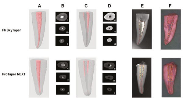 The retreatment abilities of ProTaper Next and F6 Skytaper: a micro-computed tomography study.