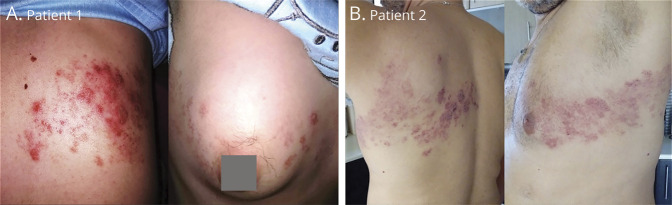 Aggressive Herpes Zoster in Young Patients With Multiple Sclerosis Under Dimethyl Fumarate: Significance of CD8<sup>+</sup> and Natural Killer Cells.