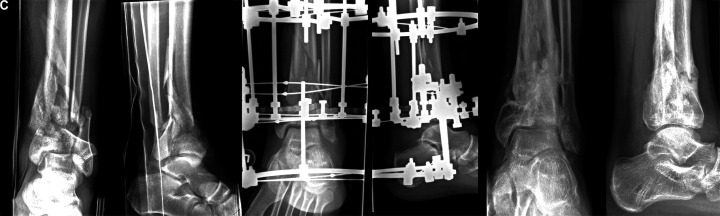 Clinical and Functional Outcomes in Patients with Distal Tibial Fracture Treated by Circular External Fixation: A Retrospective Cohort Study.