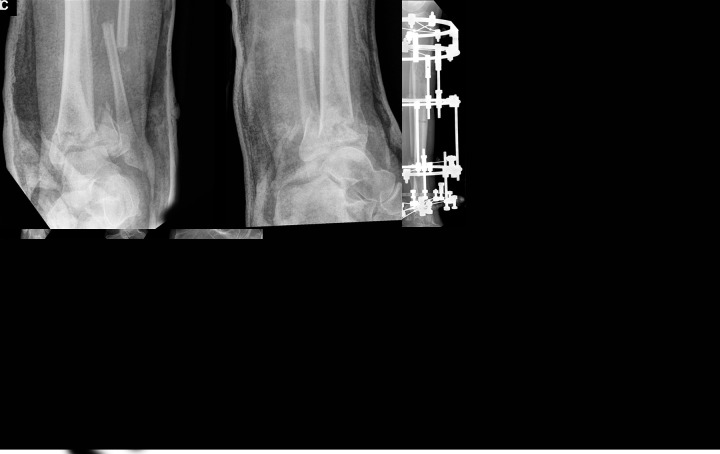 Clinical and Functional Outcomes in Patients with Distal Tibial Fracture Treated by Circular External Fixation: A Retrospective Cohort Study.