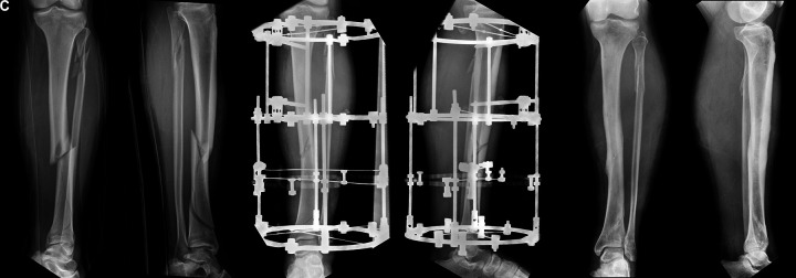 Clinical and Functional Outcomes in Patients with Distal Tibial Fracture Treated by Circular External Fixation: A Retrospective Cohort Study.