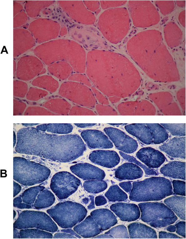 Identification of a novel MICU1 nonsense variant causes myopathy with extrapyramidal signs in an Iranian consanguineous family.