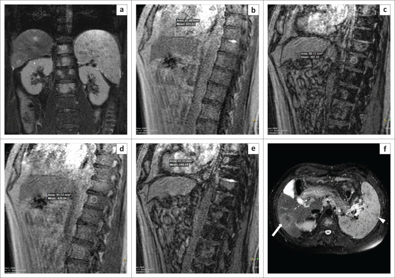 Chemical shift imaging: An indispensable tool in diagnosing musculoskeletal pathologies.