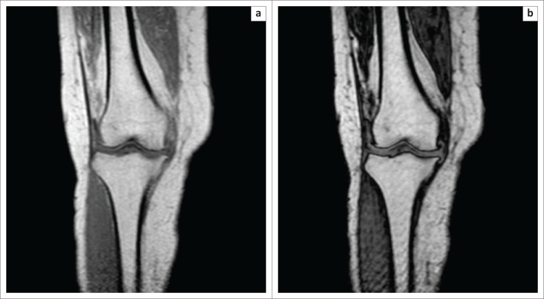 Chemical shift imaging: An indispensable tool in diagnosing musculoskeletal pathologies.