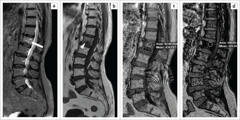 Chemical shift imaging: An indispensable tool in diagnosing musculoskeletal pathologies.