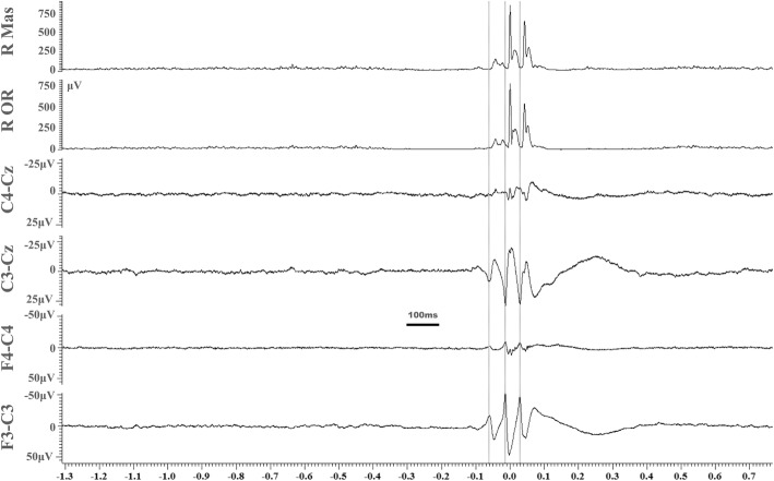 Glycine receptor antibodies and coeliac disease-related neurological dysfunction.