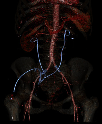 Asynchronous Bilateral Ureteric-Arterial Fistula: Diagnosis and Treatment.