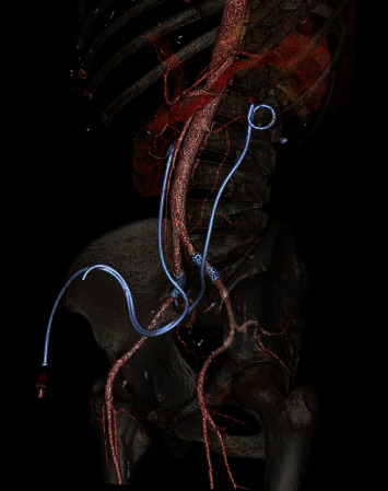 Asynchronous Bilateral Ureteric-Arterial Fistula: Diagnosis and Treatment.