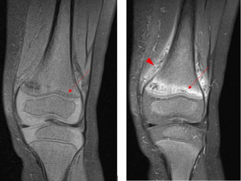 Bony Lesions in Paediatric Acute Leukaemia.