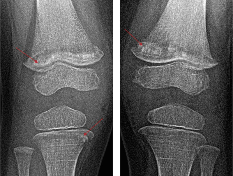 Bony Lesions in Paediatric Acute Leukaemia.