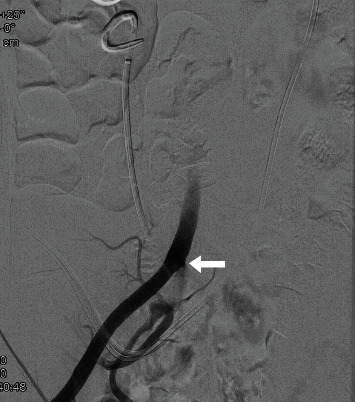 Asynchronous Bilateral Ureteric-Arterial Fistula: Diagnosis and Treatment.