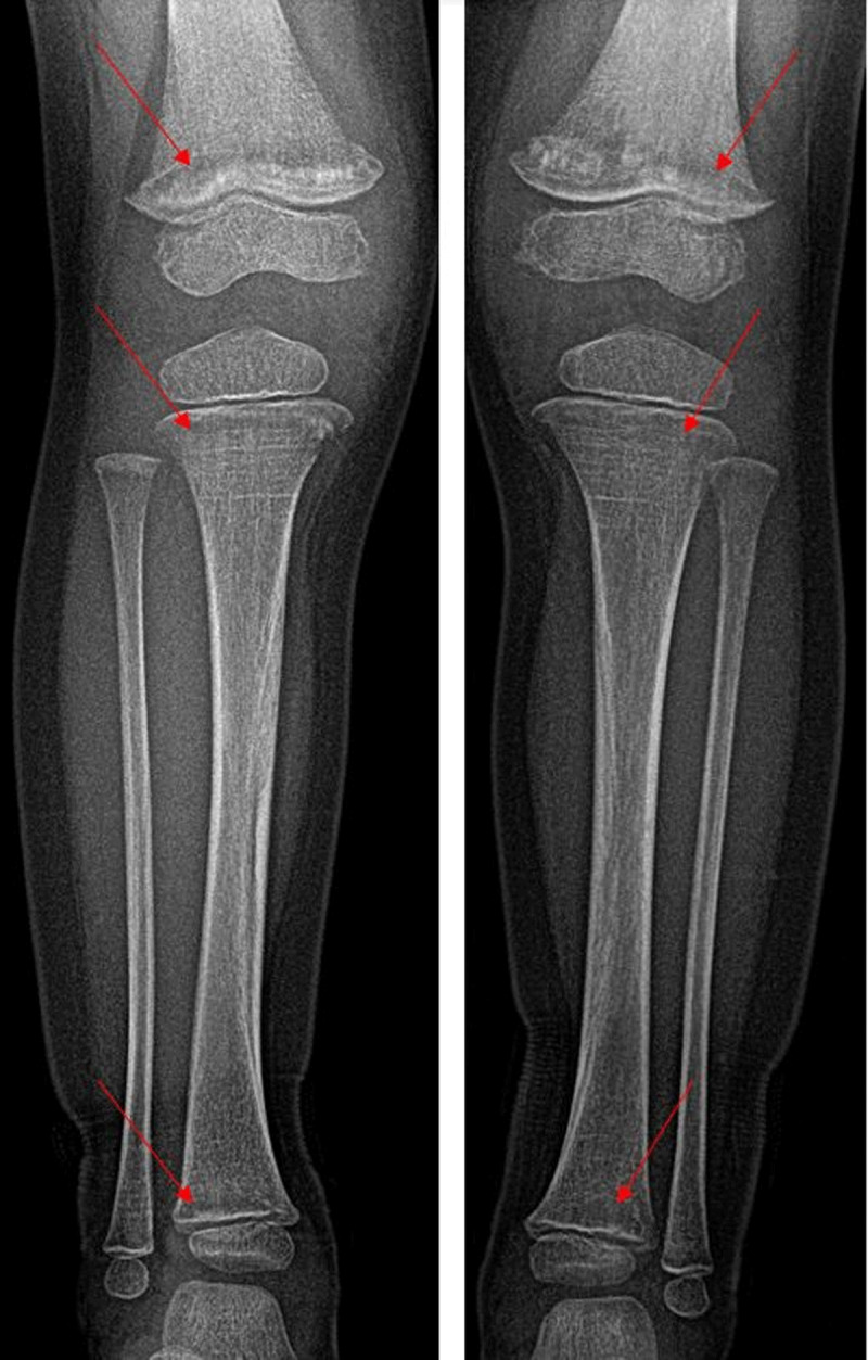 Bony Lesions in Paediatric Acute Leukaemia.