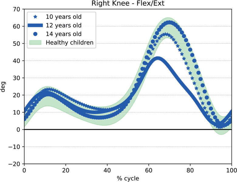 A Multidisciplinary Approach to Optimizing Long-Term Functional Prognosis of A Girl With Quadriceps Fibrosis.